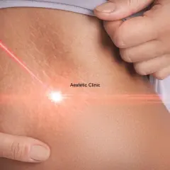 Czerwony promień lasera skierowany na skórę z widocznymi rozstępami. Zabieg w Aestetic Clinic.