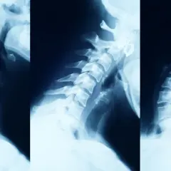 Objawy neurologiczne zwyrodnienia kręgosłupa: Kiedy do lekarza?