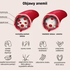Ilustracja pokazuje, co to jest anemia: porównanie poziomu żelaza we krwi i objawy, takie jak bladość, zmęczenie, bóle głowy.