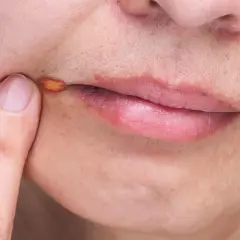 Zajady: Skuteczne leki bez recepty i kiedy do lekarza?