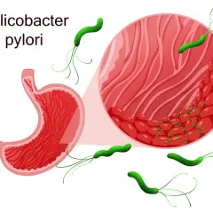 Grafika przedstawia żołądek i powiększony fragment jego błony śluzowej z bakteriami Helicobacter pylori. Skuteczne helicobacter pylori leczenie jest kluczowe.