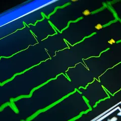 Twój wynik EKG: Obniżenie odcinka ST co to znaczy?