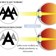 Oko z krótkowzrocznością pokazuje, jak wydłużona gałka oczna powoduje niewyraźne widzenie odległych przedmiotów, w przeciwieństwie do oka bez wady.