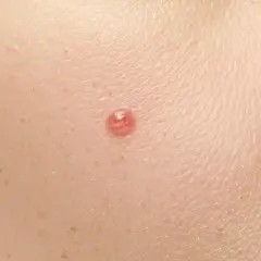Zbliżenie na skórę z widocznym pieprzykiem, idealne do analizy podczas dermatoskopii.