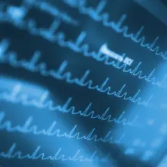 Migotanie przedsionków: Rozpoznaj objawy, uniknij udaru. Działaj!