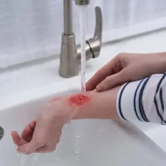 Ręka z czerwonymi, bolesnymi oparzeniami jest chłodzona pod bieżącą wodą z kranu w białej umywalce.