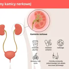 Ilustracja przedstawia przyczyny kamicy nerkowej: niedobór płynów, witamin, siedzący tryb życia, nadwagę, choroby układu pokarmowego i moczowo-płciowego, nieodpowiednią dietę oraz predyspozycje genetyczne.
