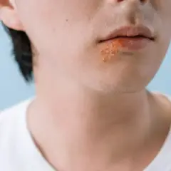 Zbliżenie na usta z opryszczką. Szukasz sposobu na opryszczkę w 1 dzień?