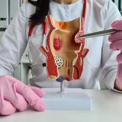 Model jelita grubego z widocznymi zmianami, wskazującymi na hemoroidy zewnętrzne.