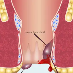Ilustracja anatomiczna hemoroidów wewnętrznych z krwawieniem.