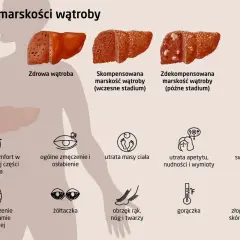 Marskość wątroby: Objawy końcowego stadium co musisz wiedzieć?
