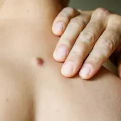 Dłoń dotyka skóry z widocznym włókniakiem, sugerując potrzebę jego usuwania.