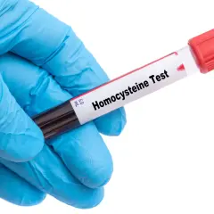 Rękawiczka medyczna trzyma probówkę z krwią do badania. Etykieta na probówce informuje: "Homocysteina Test". Badanie homocysteiny co to jest, pomoże ocenić ryzyko chorób serca.
