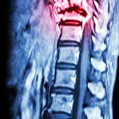 Czy to przerzuty do kości? Objawy i wczesna diagnoza