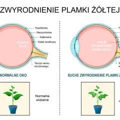 Porównanie zdrowego oka z suchym zwyrodnieniem plamki żółtej. W chorym oku plamka żółta jest uszkodzona, co prowadzi do centralnej utraty wzroku, jak na obrazku rośliny.