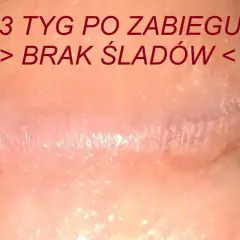 Skóra po zabiegu, gładka, bez śladów, jak perliste grudki.