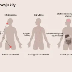 Ilustracja przedstawia stadia rozwoju kiły: pierwotna (wrzód), wtórna (wysypka) i utajona (uszkodzenie narządów).