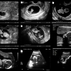 Jak wyglądają badania prenatalne w 12 tyg. ciąży? Rozwiej obawy!