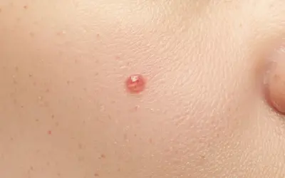 Zbliżenie na skórę z widocznym pieprzykiem, idealne do analizy podczas dermatoskopii.