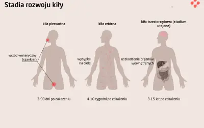 Ilustracja przedstawia stadia rozwoju kiły: pierwotna (wrzód), wtórna (wysypka) i utajona (uszkodzenie narządów).