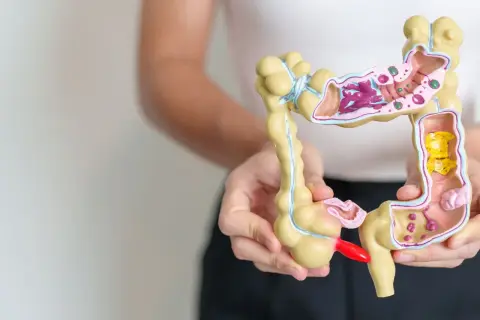 Model jelita grubego z widocznymi zmianami, które mogą symbolizować częste gazy i raka.