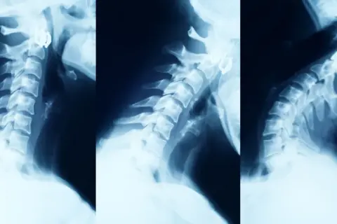Objawy neurologiczne zwyrodnienia kręgosłupa: Kiedy do lekarza?