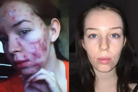 Przed i po leczeniu izotretynoiną: skóra z ciężkim trądzikiem i skóra po terapii.