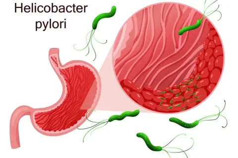 Grafika przedstawia żołądek i powiększony fragment jego błony śluzowej z bakteriami Helicobacter pylori. Skuteczne helicobacter pylori leczenie jest kluczowe.