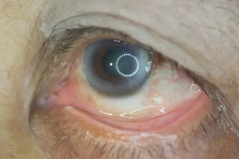 Oko z zaczerwienionymi naczynkami i białymi grudkami na powiece, sugerujące stan zapalny lub retinopatię.