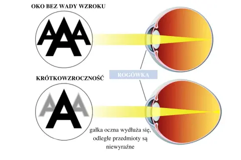 Oko z krótkowzrocznością pokazuje, jak wydłużona gałka oczna powoduje niewyraźne widzenie odległych przedmiotów, w przeciwieństwie do oka bez wady.