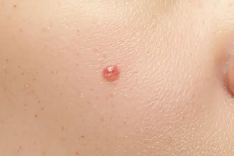 Zbliżenie na skórę z widocznym pieprzykiem, idealne do analizy podczas dermatoskopii.