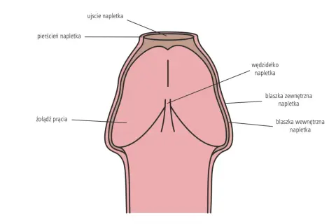 Schemat penisa z napletkiem. Pokazuje, co to stulejka – zwężenie napletka utrudniające jego odprowadzenie.