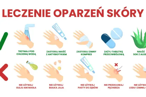 Leczenie oparzeń skóry: chłodna woda, maść z antybiotykiem, zimny kompres, leki przeciwbólowe, aloes. Unikaj masła, jajka, pasty do zębów, lodu. Nie przekłuwaj pęcherza.