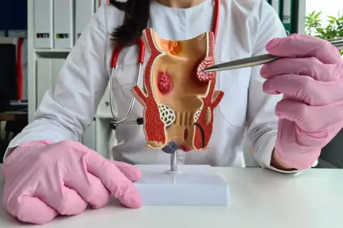 Model jelita grubego z widocznymi zmianami, wskazującymi na hemoroidy zewnętrzne.