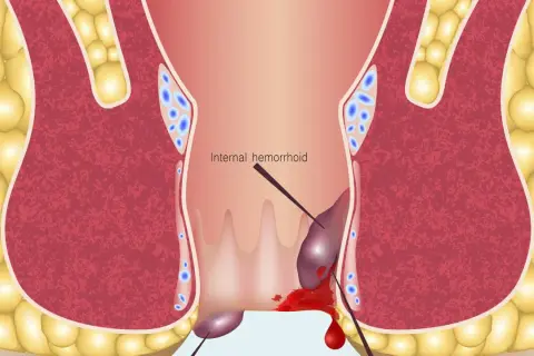 Ilustracja anatomiczna hemoroidów wewnętrznych z krwawieniem.
