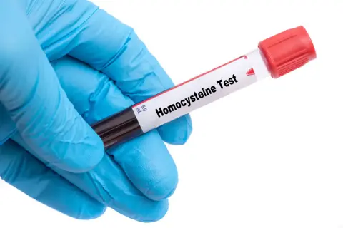 Rękawiczka medyczna trzyma probówkę z krwią do badania. Etykieta na probówce informuje: "Homocysteina Test". Badanie homocysteiny co to jest, pomoże ocenić ryzyko chorób serca.