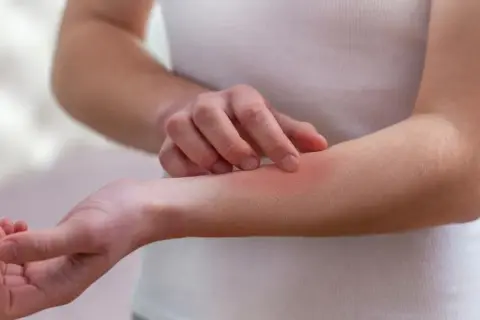 Ręka z zaczerwienioną skórą, która swędzi. Może to być objaw choroby autoimmunologicznej, takiej jak lupus.