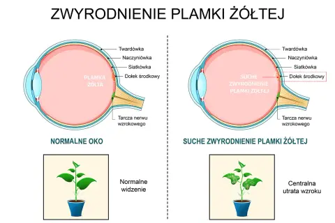 Porównanie zdrowego oka z suchym zwyrodnieniem plamki żółtej. W chorym oku plamka żółta jest uszkodzona, co prowadzi do centralnej utraty wzroku, jak na obrazku rośliny.
