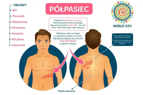 Infografika o półpaścu, jego objawach i wirusie VZV. Pokazuje wykwity skórne na tułowiu, sugerując potrzebę leczenia.