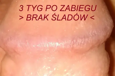 Skóra po zabiegu, gładka, bez śladów, jak perliste grudki.