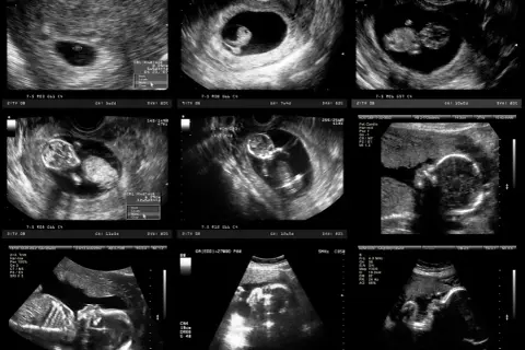 Jak wyglądają badania prenatalne w 12 tyg. ciąży? Rozwiej obawy!