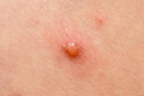 Widoczne na skórze zaczerwienienie i pęcherzyk, być może początek kaszaków.