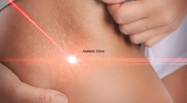 Czerwony promień lasera skierowany na skórę z widocznymi rozstępami. Zabieg w Aestetic Clinic.