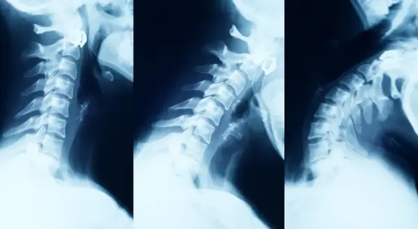 Objawy neurologiczne zwyrodnienia kręgosłupa: Kiedy do lekarza?