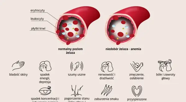 Ilustracja pokazuje, co to jest anemia: porównanie poziomu żelaza we krwi i objawy, takie jak bladość, zmęczenie, bóle głowy.