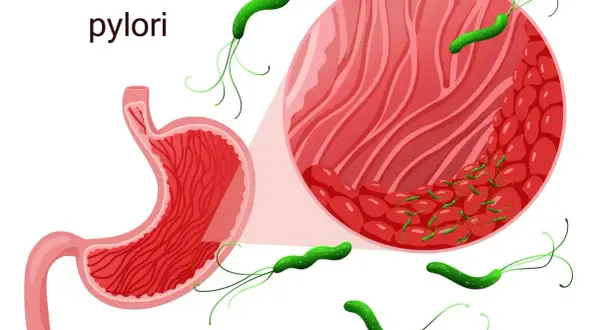 Grafika przedstawia żołądek i powiększony fragment jego błony śluzowej z bakteriami Helicobacter pylori. Skuteczne helicobacter pylori leczenie jest kluczowe.