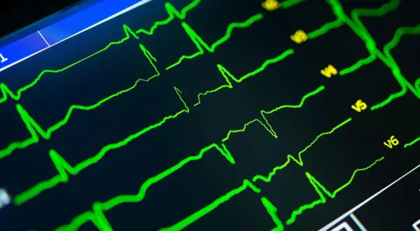 Twój wynik EKG: Obniżenie odcinka ST co to znaczy?