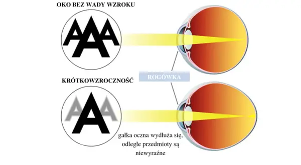 Oko z krótkowzrocznością pokazuje, jak wydłużona gałka oczna powoduje niewyraźne widzenie odległych przedmiotów, w przeciwieństwie do oka bez wady.