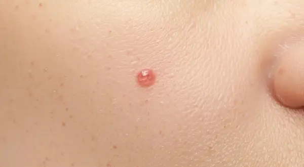 Zbliżenie na skórę z widocznym pieprzykiem, idealne do analizy podczas dermatoskopii.