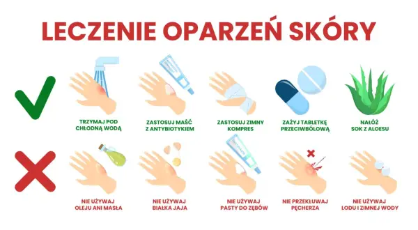 Leczenie oparzeń skóry: chłodna woda, maść z antybiotykiem, zimny kompres, leki przeciwbólowe, aloes. Unikaj masła, jajka, pasty do zębów, lodu. Nie przekłuwaj pęcherza.